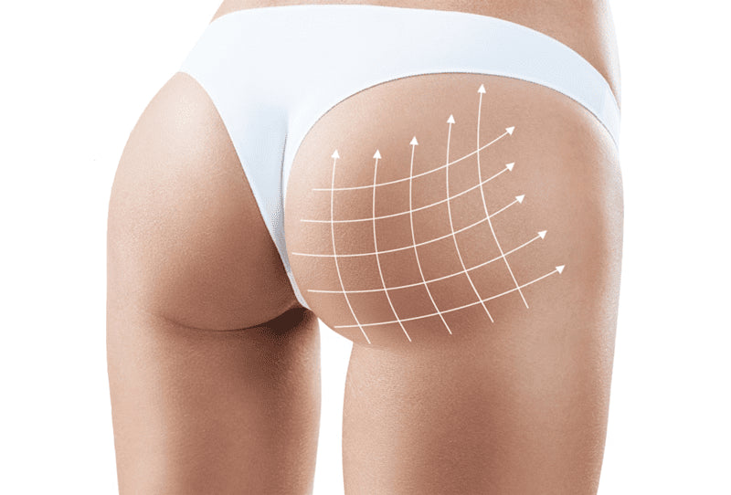 Butt Lift Treatment (Package of 6 session)